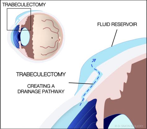 cpt code for trabeculectomy with mitomycin c|Coding for Minimally Invasive Glaucoma Surgery